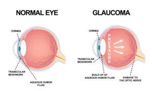 Understanding the Reality of Glaucoma