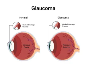 What Is Glaucoma Surgery?